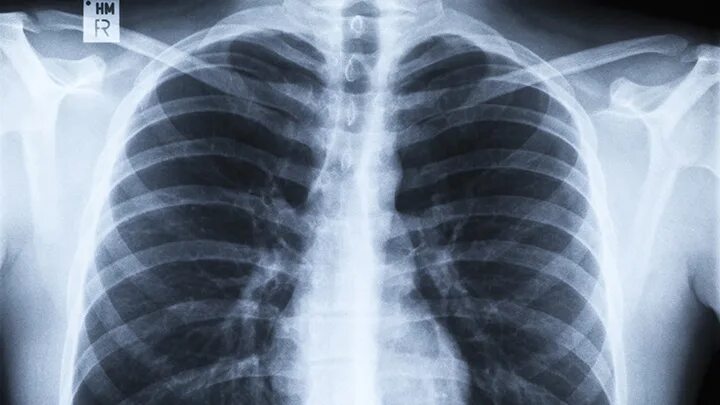 Рентген легких здорового человека. Фото легких здорового человека.