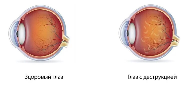 Ретинопатия катаракта глаукома. Помутнение стекловидного тела глаза. Деструкция стекловидного тела. Прозрачное тело в глазу