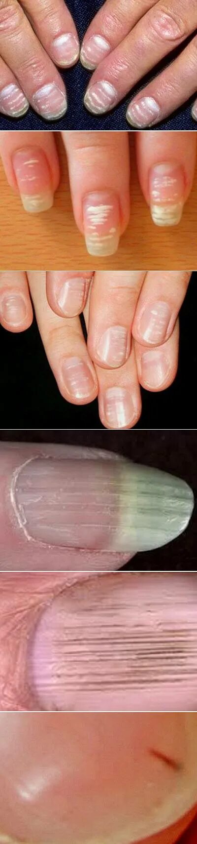 Лечение продольных полос на ногтях. Ониходистрофия, лейконихия. Вертикальные полосы на ногтях. Поперечные полосы на ногтях. Поперечные белые полоски на ногтях.