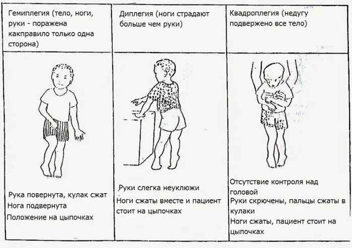 Дцп двойная спастическая гемиплегия. Дцп двойная спастическая гемиплегия. Гемиплегическая форма дцп характеристика. Дцп двойная спастическая гемиплегия. Двойная спастическая гемиплегия.