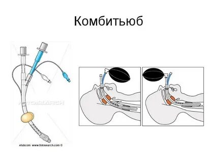 Приемы в анестезиологии