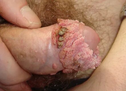 this weird dick warts really annoying me what happens if 