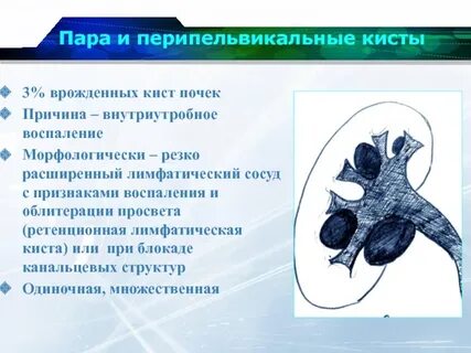 Парапельвикальная киста почки