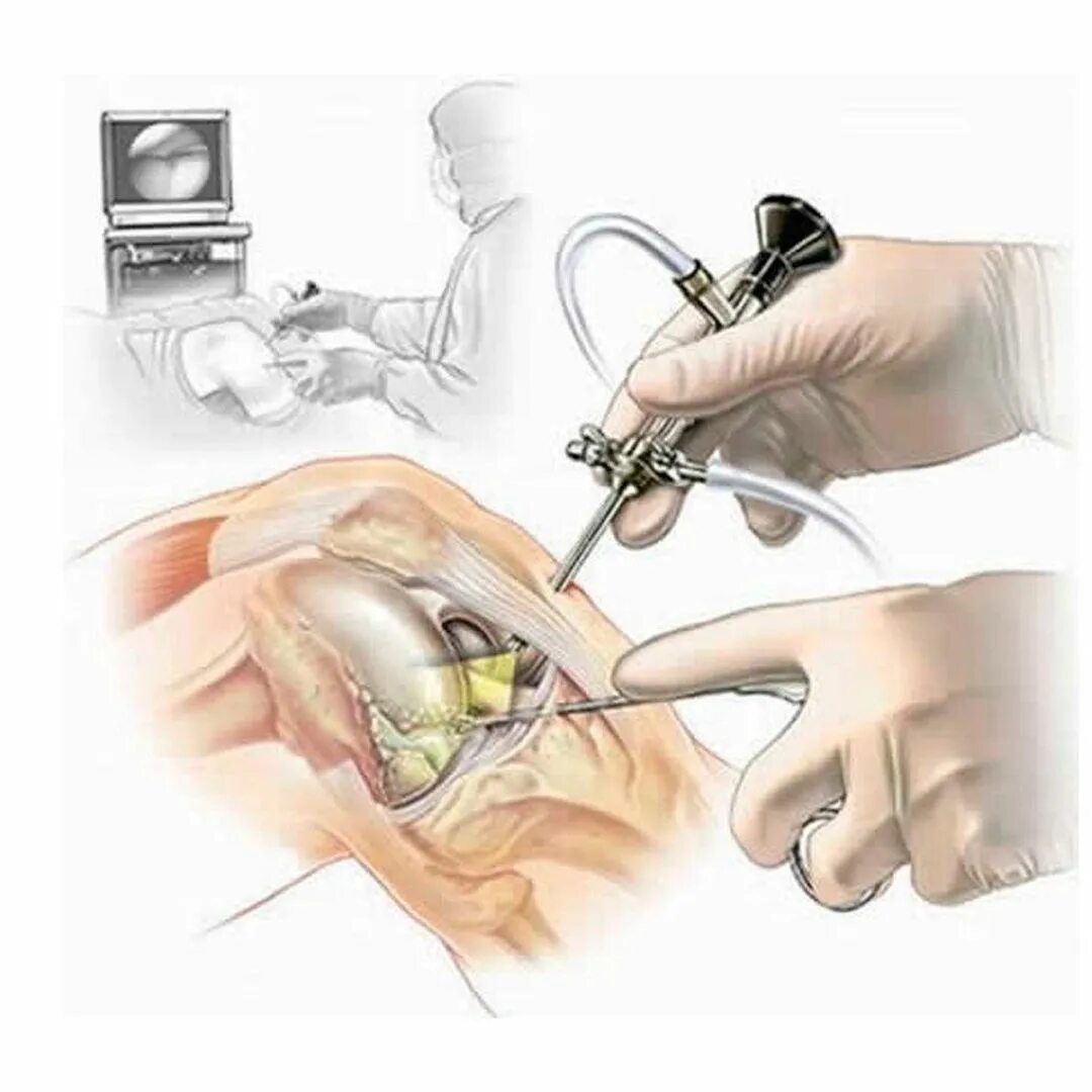 артроскопия менисков коленного сустава. артроскопия коленного сустава резекция мениска. дренирование коленного сустава. операция артроскопия коленного сустава. порты при артроскопии коленного сустава.