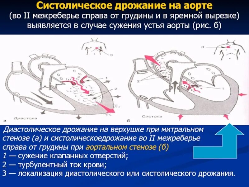 Нервная дрожь. Сердечная дрожь. Дрожание грудной клетки. Сердечная дрожь. Учащение пульса и дыхания характеризует состояние.