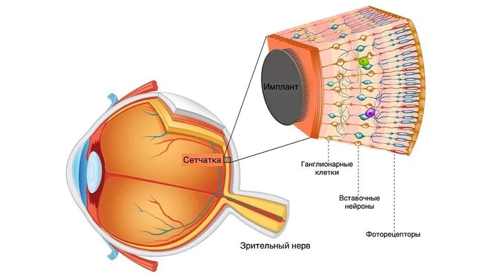Сетчатка. Искусственная сетчатка глаза. Имплантаты сетчатки. Сетчатая оболочка глаза.