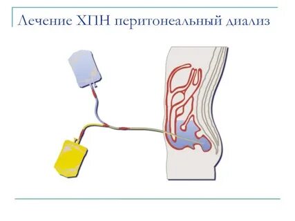 Диализ брюшной полости