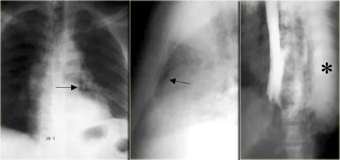 Перфорация пищевода медиастинит. Спонтанный разрыв пищевода рентген. Перфорация пищевода рентгенограмма. Синдром Бурхаве рентген. Синдром пищевода