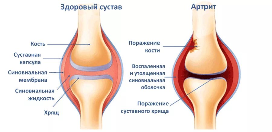 Изменения в коленных суставах. Артрит коленного сустава схема. Синовиальная мембрана коленного сустава. Строение сустава синовиальная оболочка. Синовиальная капсула коленного сустава.