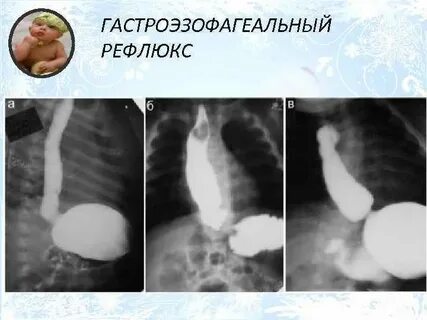 Рефлюкс у новорожденных
