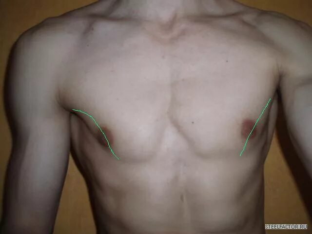Асимметрия грудных мышц. Асимметричная грудная клетка. Асимметрия грудной клетки у мужчин. Недоразвитие грудной мышцы.