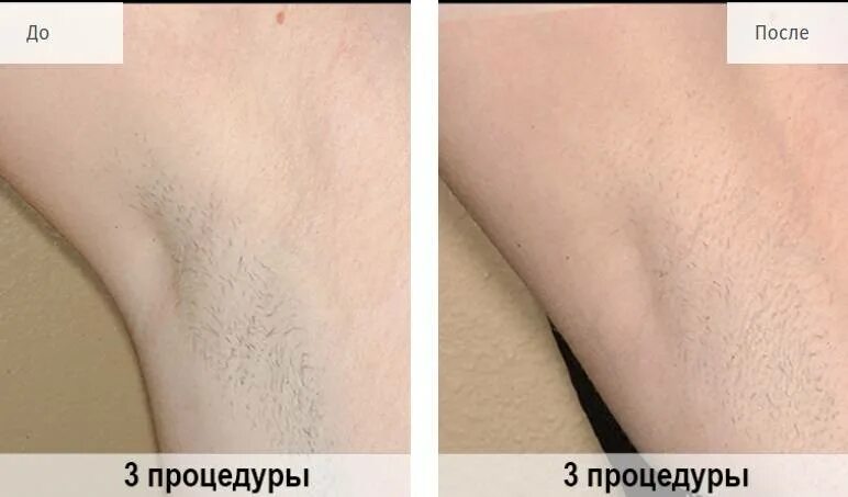 Фотоэпилятор эффект. Лазерная эпиляция до и после 1 процедуры глубокое бикини. Электроэпиляция глубокого бикини. Фотоэпиляция лазерная глубокое бикини. Бикини до лазерной эпиляции.