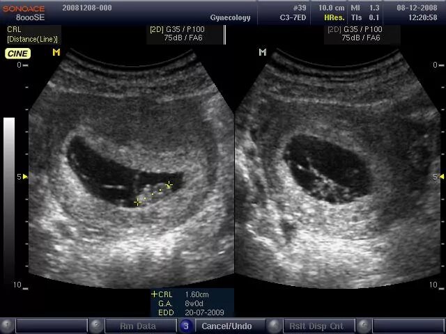 Перепутали кисту с беременностью. УЗИ многоплодной беременности на ранних. Фото УЗИ многоплодной беременности на ранних сроках. Когда виден ребенок на узи