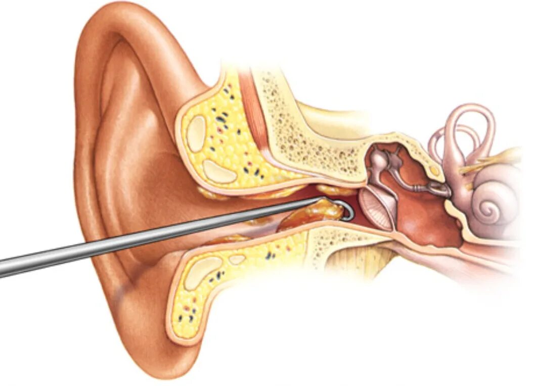 Заложило ухо пробка что делать. Отомикоз серная пробка.