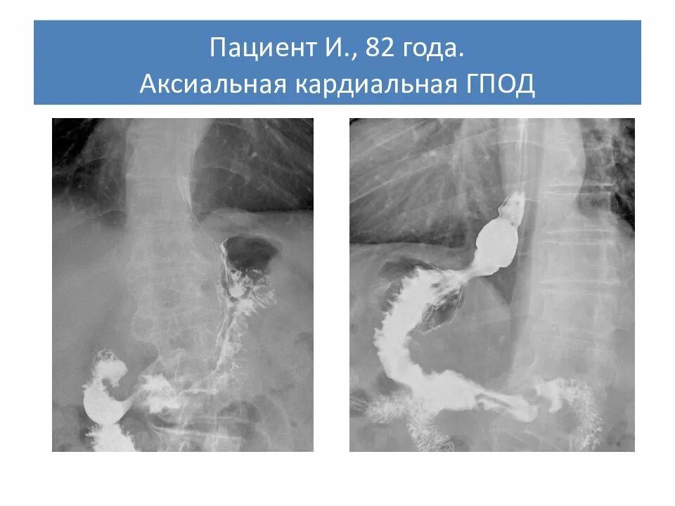 Кардиальная грыжа под. Грыжа диафрагмы пищевода рентген. Аксиальная грыжа пищевода рентген. Скользящая грыжа пищевода рентген. Грыжа пищевого отверстия диафрагмы рентген.