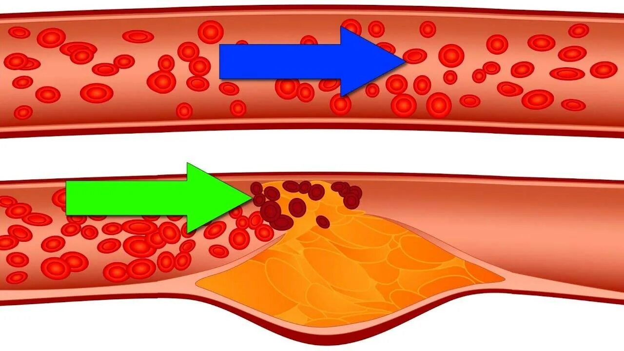 От бляшек и тромбов как очистить. Холестериновые бляшки в сосудах. Что такое холестериновых бляшек и закупорки сосудов. Кровеносные сосуды забиты.