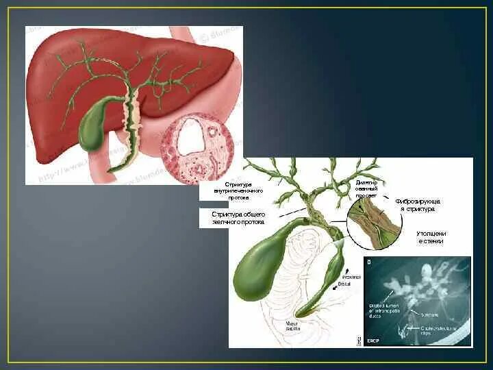 Болезни желчного протока. Стенозов внепеченочных желчных протоков. Рубцовые стриктуры желчных протоков. Рубцовые стриктуры желчевыводящих путей. Рубцовые сужения общего желчного протока.