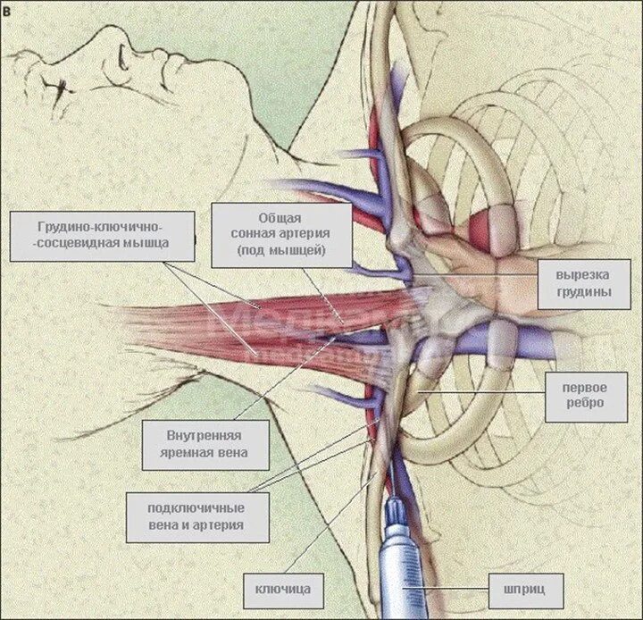 Правая подключичная вена. Внутренняя яремная Вена катетеризация. Яремная и подключичная Вена. Подключичная Вена анатомия топография. Постановка ЦВК подключичной вены.