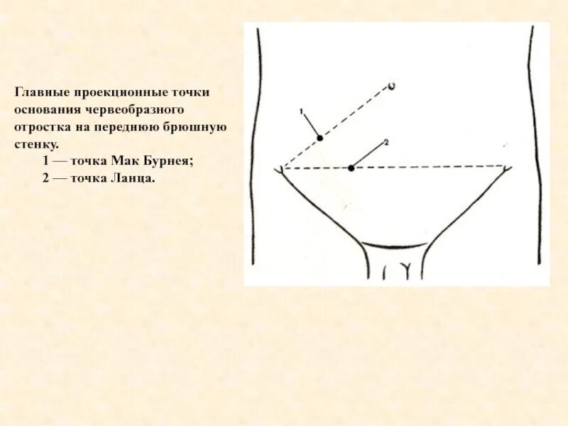 Точки аппендицита. Точка Ланца и Мак Бурнея. Точка Мак Бурнея и Ланца при аппендиците. Болевые точки Мак Бурнея Ланца. Проекционные точки Ланца и Мак Бурнея.