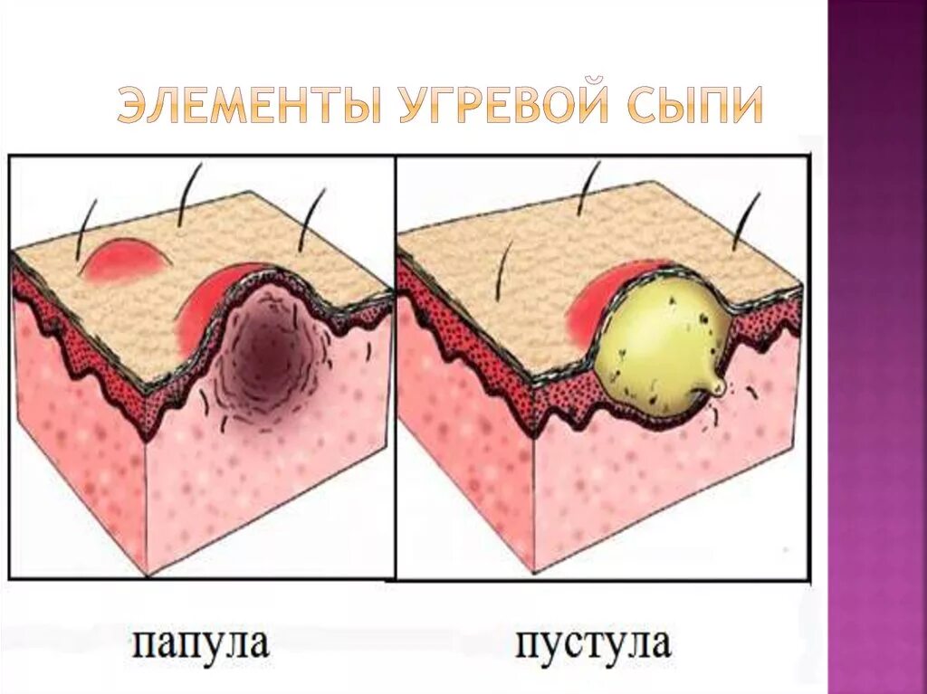 Папула элемент. Пустула морфологический элемент. папула везикула первичные элементы. первичные морфологические элементы кожи пустула.