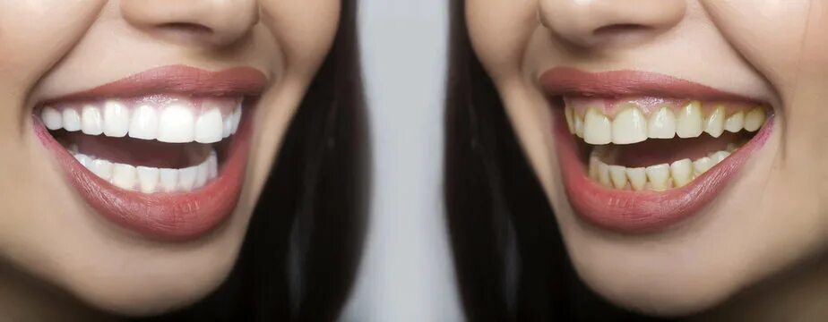 "Yellow Teeth" Изображения: просматривайте стоковые фотографии, векторные изобра