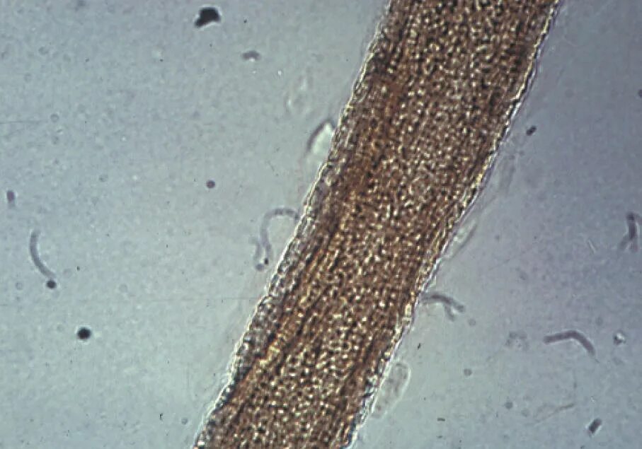 Trichophyton микроскопия. Поверхностная трихофития микроскопия. Трихофития и микроспория под микроскопом. На коже обнаружены споры