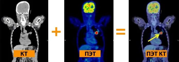 Позитрон-эмиссионная  томография: ПЭТ. ПЭТ-кт всего тела с 18f-фтордезоксиглюкозой. Позитронно эмиссионная томография онкология. Позитронно-эмиссионная томография снимки мозга. Пэт кт или кт что лучше
