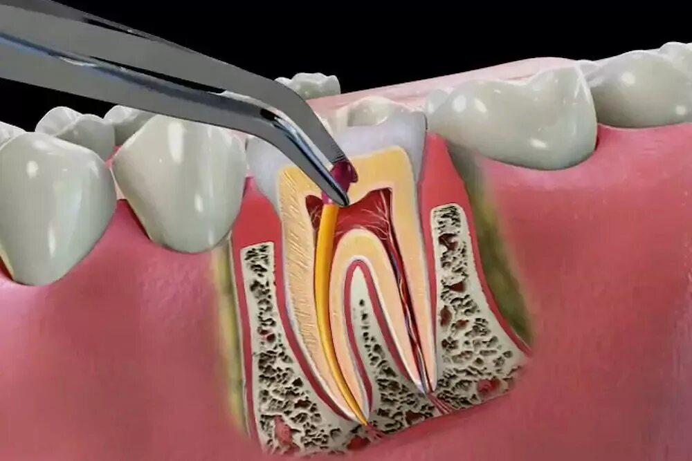 4 Канальный пульпит зуба. Пульпит зуба 3 канального зуба. Пульпита (депульпирование зуба.