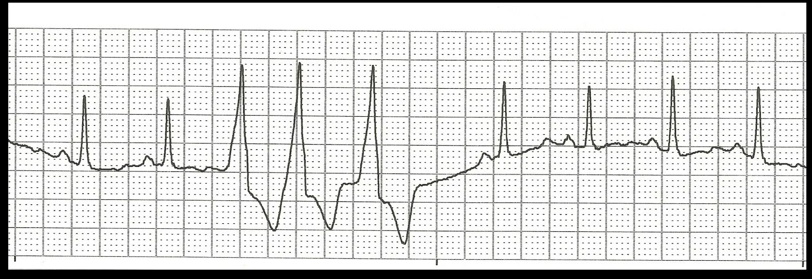 Типичный ритм ритм сердца. Ритм коронарного синуса. electrocardiogram sinus normal.
