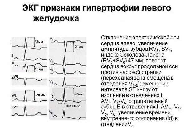 Причины гипертрофии левого желудочка. ЭКГ при гипертрофии обоих желудочков. Гипертрофия левого желудочка ЭКГ схема. Заключение ЭКГ при гипертрофии левого желудочка. Гипертрофия лж на ЭКГ.