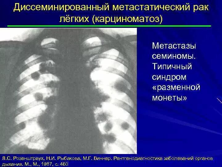 Единичные метастазы в легких. Единичные метастазы в легких