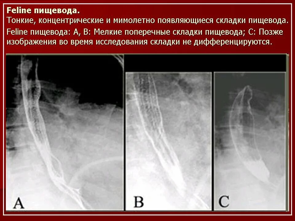 Пищевод складки слизистой. Утолщение складок пищевода рентген. Поперечные складки пищевода. Эзофагокардиомиотомия по Хеллеру.