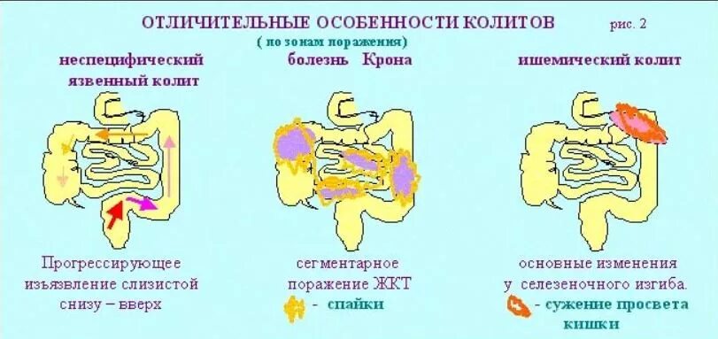 Болезнь крона кишечника симптомы лечение. Спастический язвенный колит хронический. Неспецифический язвенный колит характерный симптом. Внекишечные симптомы язвенного колита. Хронический спастический колит патогенез.