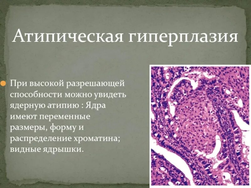 Атипическая гиперплазия гистология. Атипическая гиперплазия эндометрия терапия. Атипическая железистая гиперплазия эндометрия. Атипическая гиперплазия эндометрия гистология. Простая железистая гиперплазия эндометрия