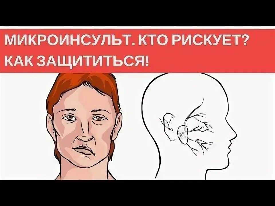 Как выглядит микроинсульт у человека Микроинсульт у мужчин: как распознать, первые признаки, симптомы, лечение, после