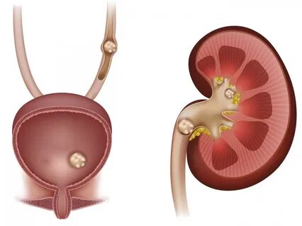 Мочекаменная болезнь (уролитиаз): лечение, виды, причины, симптомы и диагностика