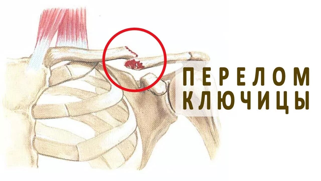 Хрустит ключица
