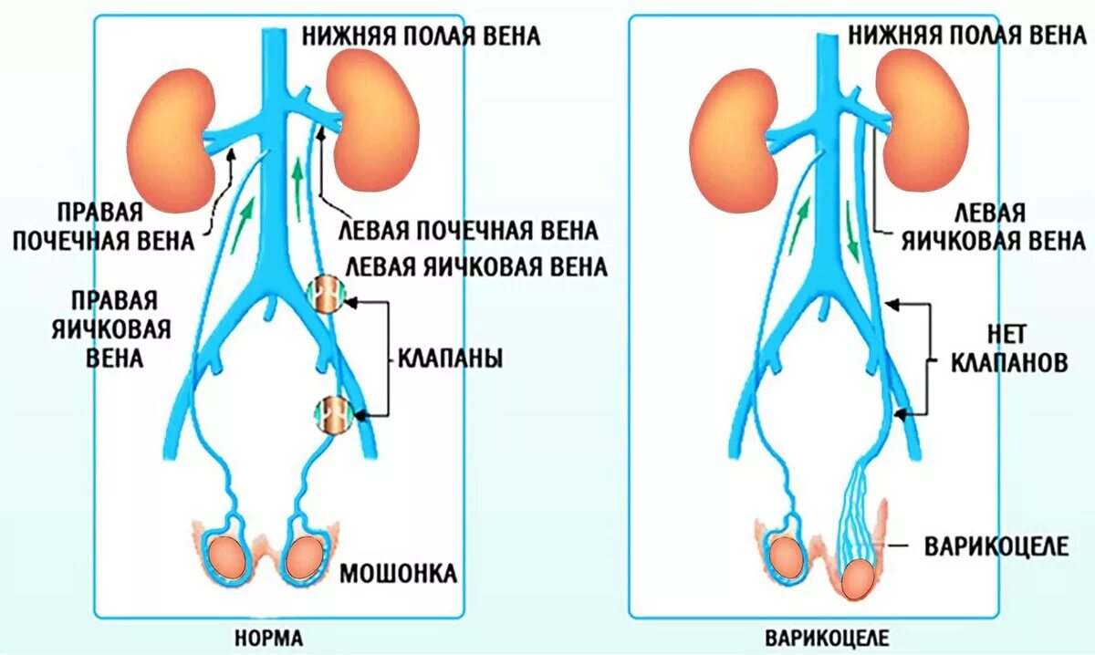 Сплетение яичка. Варикозное расширение вен семенного канатика.