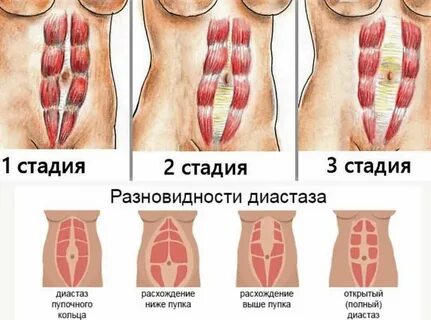 Диастаз брюшной полости