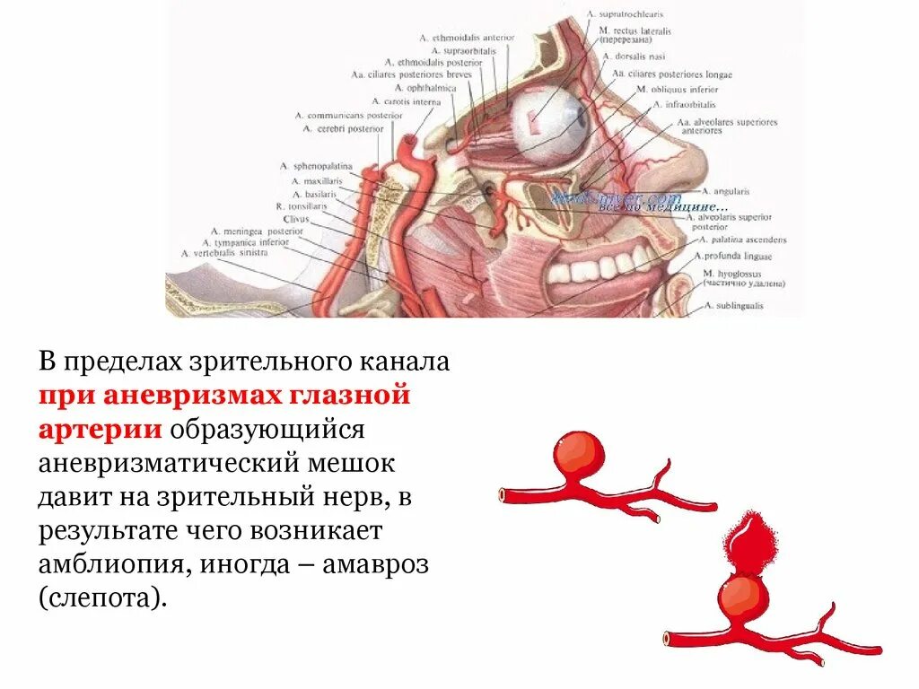 Аневризма глазной артерии. Аневризма сосудов глаза. Аневризмы головного мозга. Аневризма зрительного нерва.