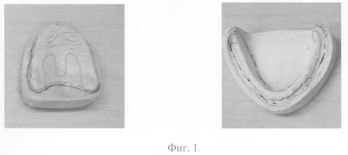 Базис с окклюзионными валиками на нижнюю челюсть. Базис с окклюзионными валиками на беззубую челюсть. Классификация беззубых челюстей (шредера, келлера, оксмана. Съемный протез из пластмассы. Протезирование беззубых челюстей.