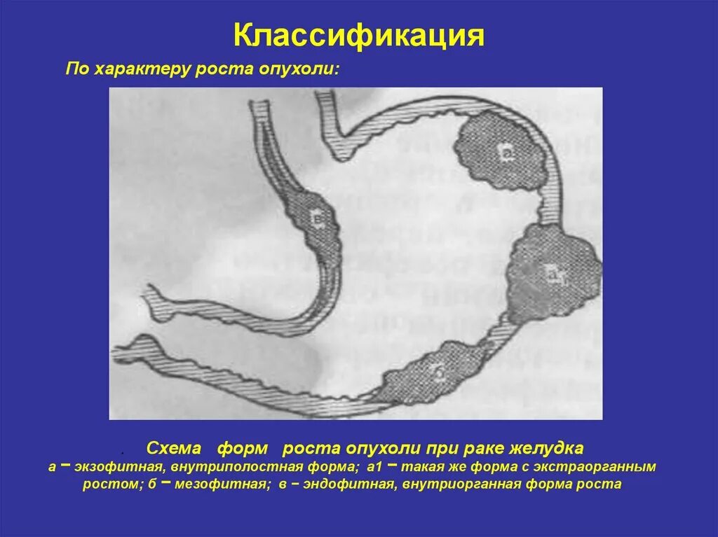 Доброкачественные опухоли желудка схема. Экзофитная форма роста опухоли желудка. Гастроинтестинальная стромальная опухоль желудка макропрепарат. Эндофитный рост опухоли