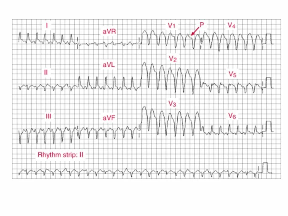 Тахикардия qrs. Полиморфная желудочковая тахикардия экг. синусовая тахиаритмия на экг. катехоламинергическая желудочковая тахикардия. аритмия экг тахиаритмия.