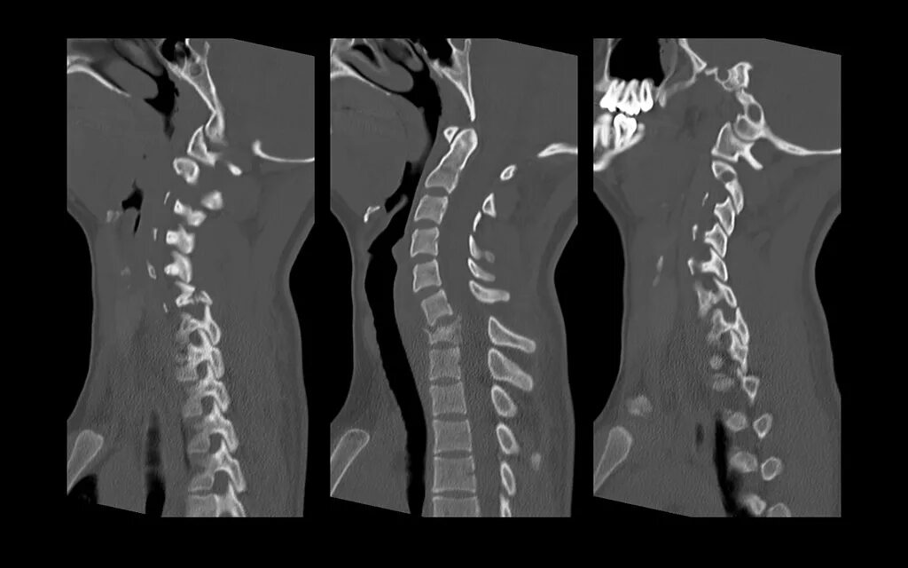 Компрессионный перелом тел c5 c6. Компрессионный перелом 5 6 шейного позвонка. Компрессионная операция на позвоночнике
