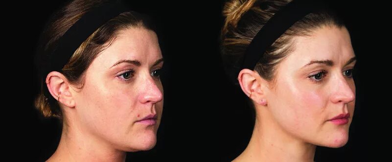 Morpheus 8 Radio Frequency Microneedling Treatment. Non-surgical skin tightening