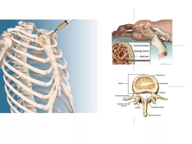 Трепанобиопсия кости. Костный мозг из грудины. Стернальная пункция грудины. Пункция костного мозга грудной клетки. Стернальная пункция костного мозга.