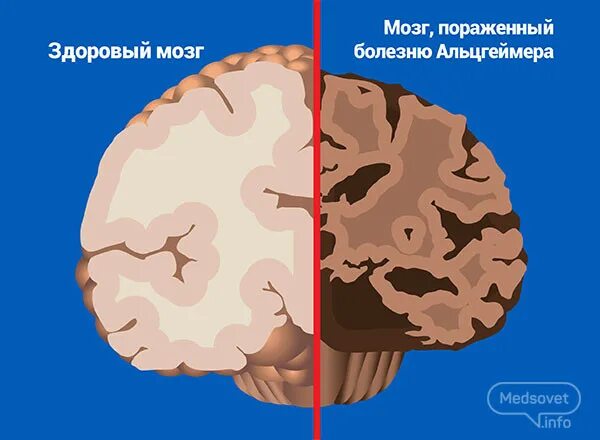 Энцефалопатия головного мозга что это такое. Кт и мрт при болезни альцгеймера. Brain frontal lobe. Мозг при болезни альцгеймера. Признаки здорового мозга.