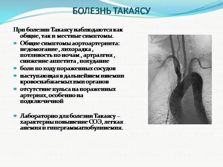 Синдром аорты. Артериит такаясу. синдромы при артериите такаясу. неспецифический аортоартериит (синдром такаясу). патогенез аортоартериита такаясу.
