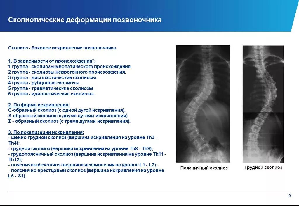 Сколиоз поясничного отдела рентген описание. Деформации грудного отдела рентген позвоночника. Описание сколиоза на рентгенограмме. Искривление позвоночника на рентгене описание. Изменение формы позвоночника