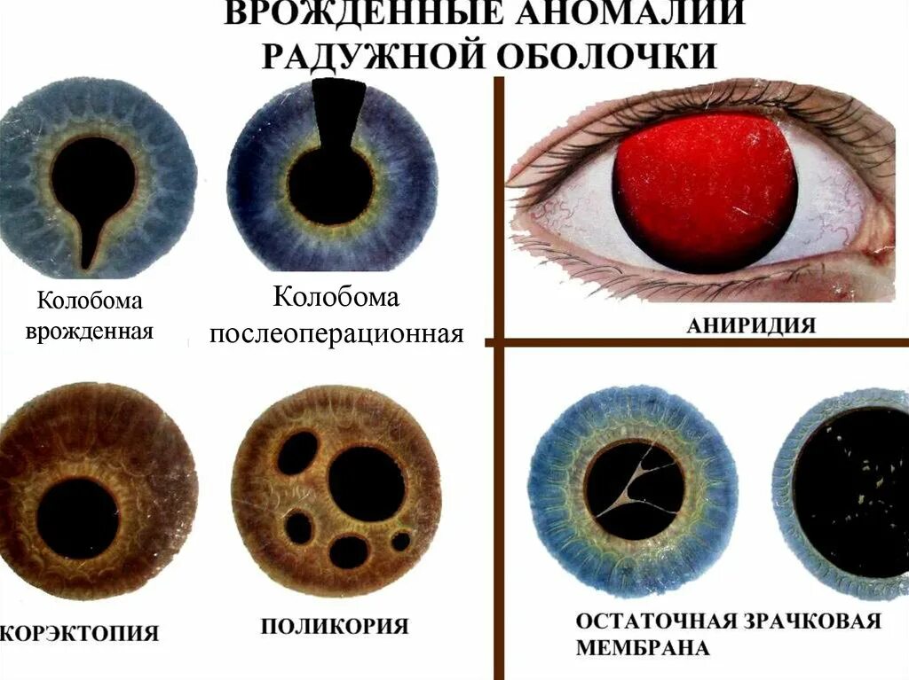 Болезни зрачка глаза. Аниридия — отсутствие радужной оболочки. врожденные аномалии сосудистой оболочки глаза. врожденная колобома сосудистой оболочки. аниридия отсутствие радужки.